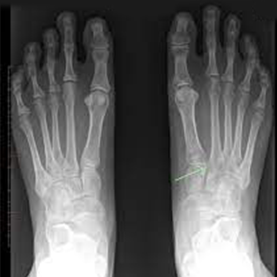 X-Ray Of Both Feet AP View (Weight Bearing) Procedure